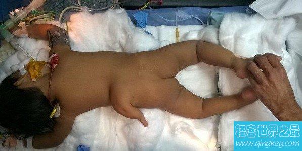 印度女婴长出三条腿，最后医生全力切除