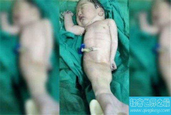印度妈妈生下现实版“美人鱼”，宝宝4小时后不幸夭折！母亲痛哭流涕！