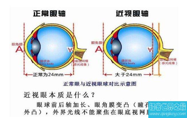 世界上最严重的的近视患者，罕见的超高近视达4800度！
