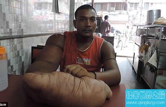 印度男子长40斤巨型手臂，被称“恶魔之子”