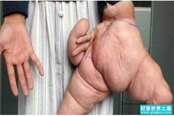 世界上最大的手是谁 中国男子刘华（整只手26厘米）