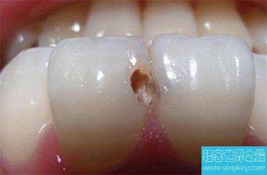 虫牙怎么办？长期清洁不当则会造成牙齿损坏