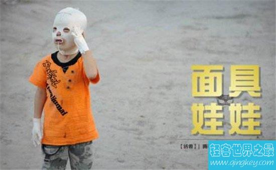面具娃娃因火灾遭到毁容，从小带着头套生活